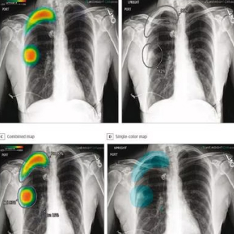 chest xray